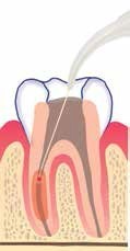 Nd:YAG Disinfection