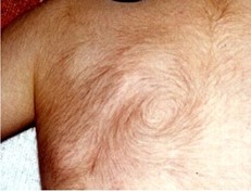 Hypertrichosis - Excessive hair growth