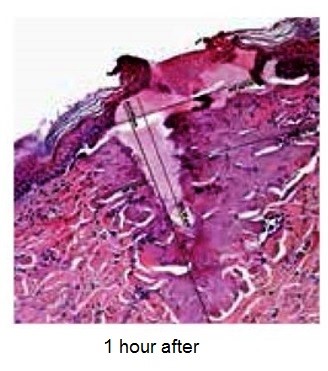 YouLaser MT 1 hour