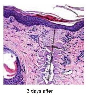 YouLaser MT 3 days