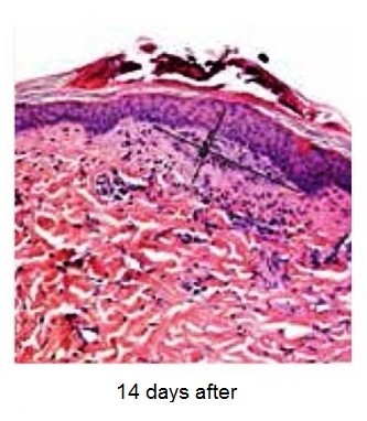 YouLaser MT 14 days