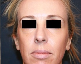 after image
